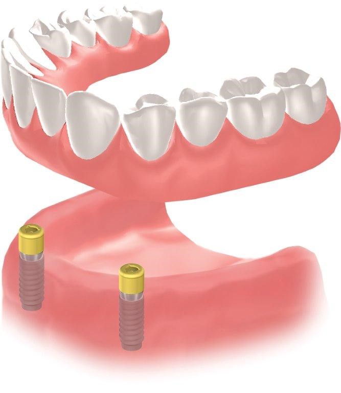 Immediate Dentures Procedure Pontotoc TX 76869